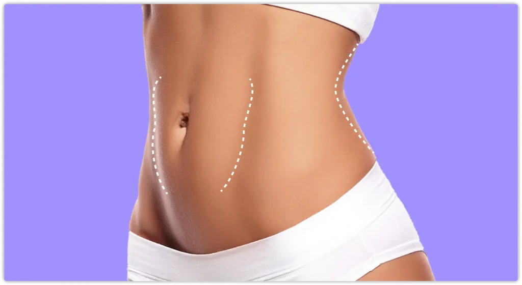 tummy tuck